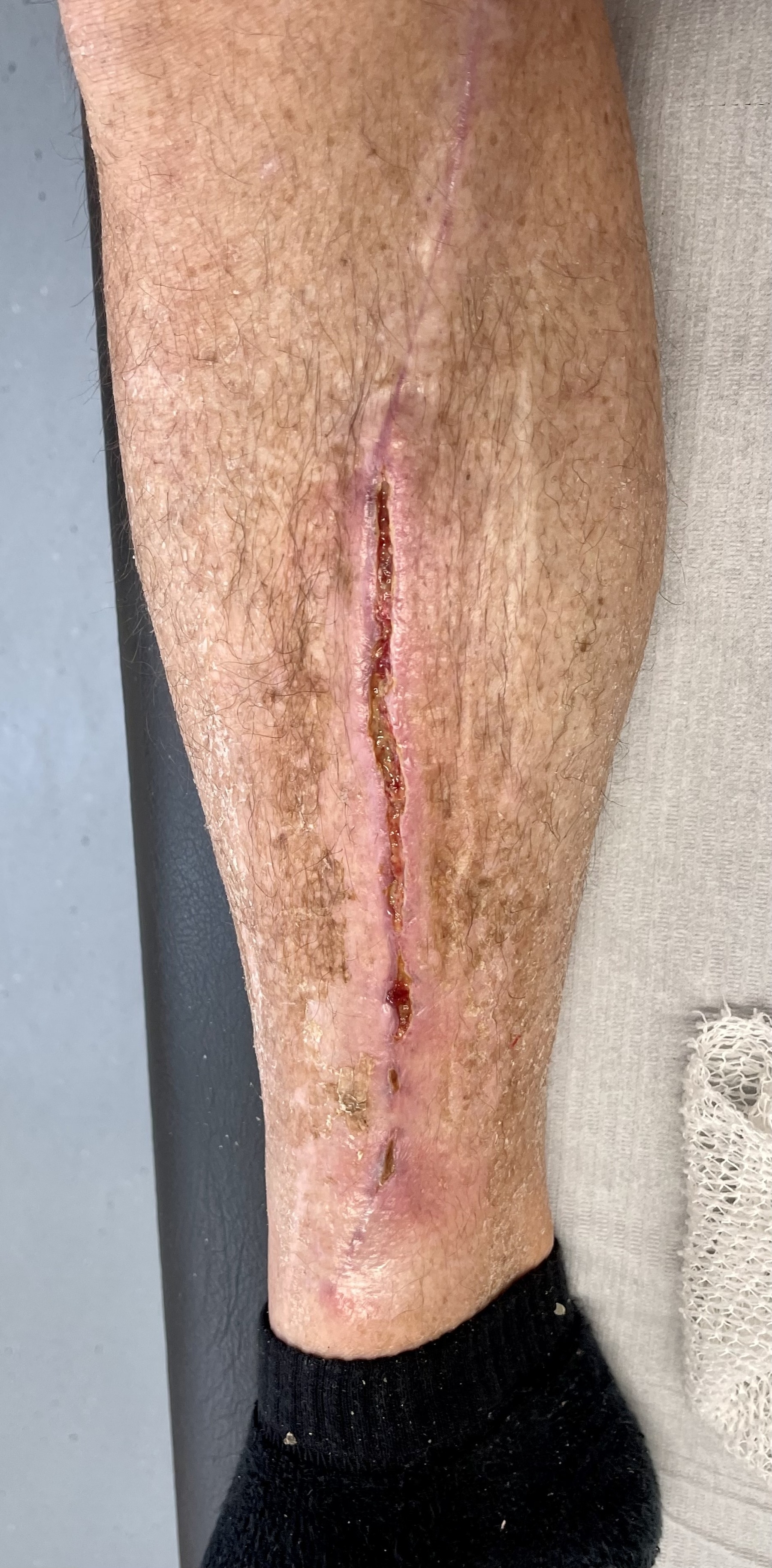 55 days post sapheous vein removal